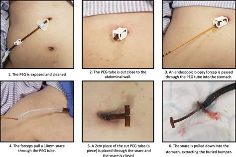 button daily bumper|Percutaneous Endoscopic Gastrostomy (PEG) Quick Reference .